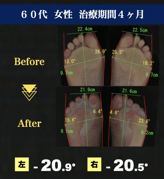 60代女性 治療期間4ヶ月